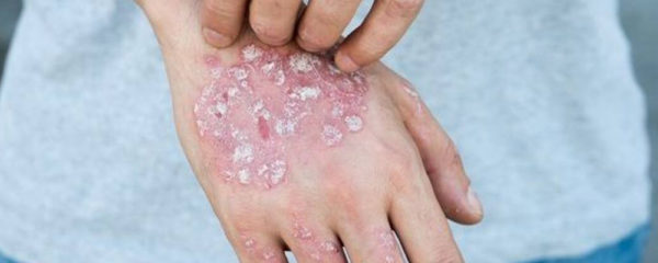 psoriasis